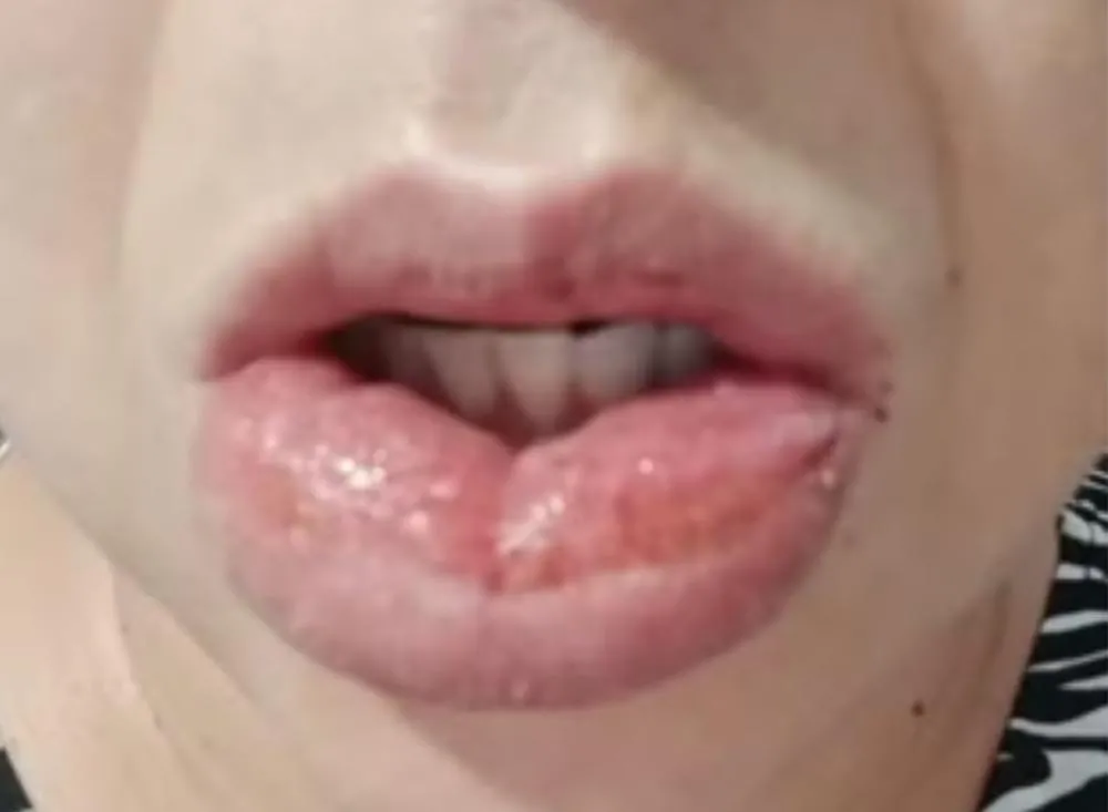Moradora do Vale do Ribeira que ficou com a boca gigante após usar creme dental vai processar Colgate / Foto: Reprodução